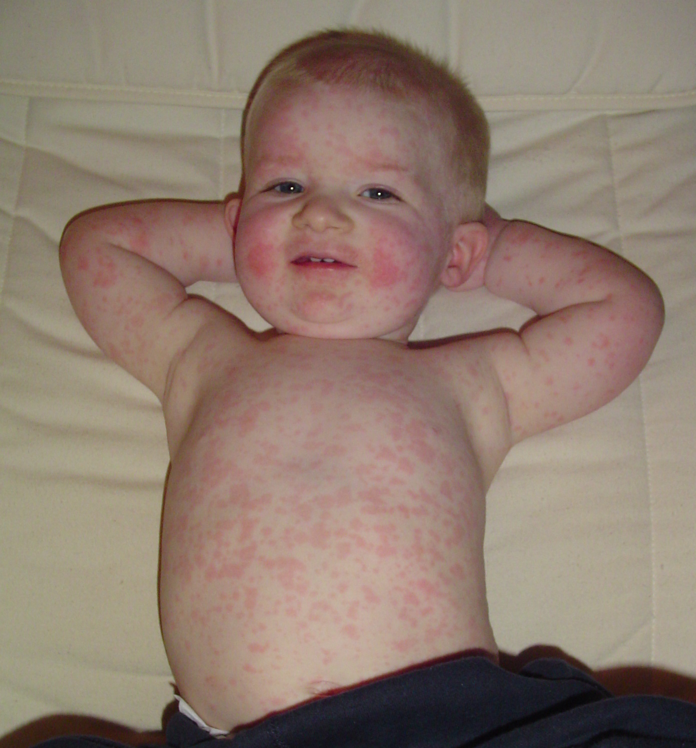 File:Fifth disease.jpg - Wikimedia Commons