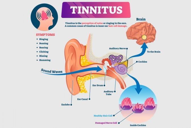 Tinnitus: Causes, Research and Treatments | Ear Wax Removal